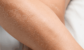 Jambe présentant les symptômes d'une peau déshydratée : peau sèche qui pèle