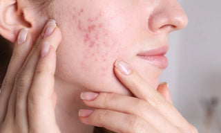 jeune femme avec de l'acné des boutons et des rougeurs sur la joue