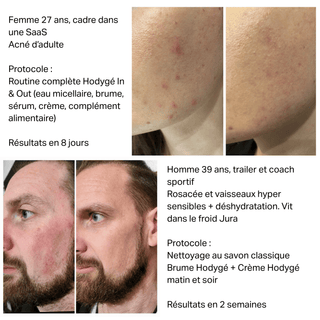 Avant/après Hodygé : réduction visible de l'acné adulte et de la rosacée sur peaux sensibles