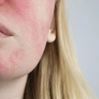 une femme à la peau hypersensible et rougeurs sur visage